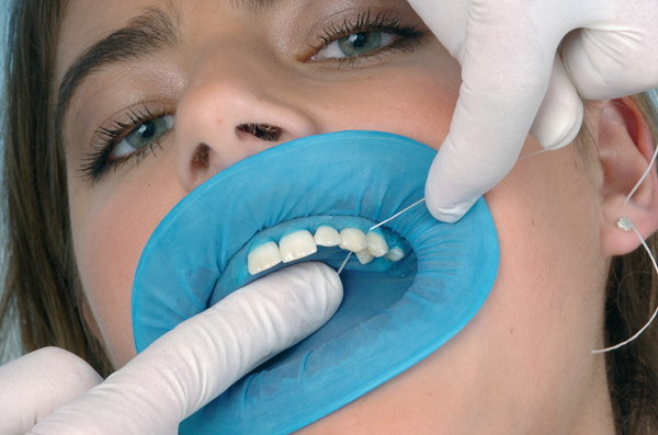 OptraDam Plus,  assort. sæt